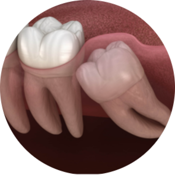 Wisdom Tooth Removal