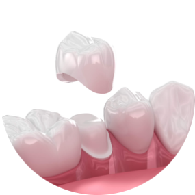 Dental Fillings