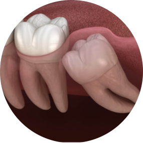 Wisdom Tooth Removal